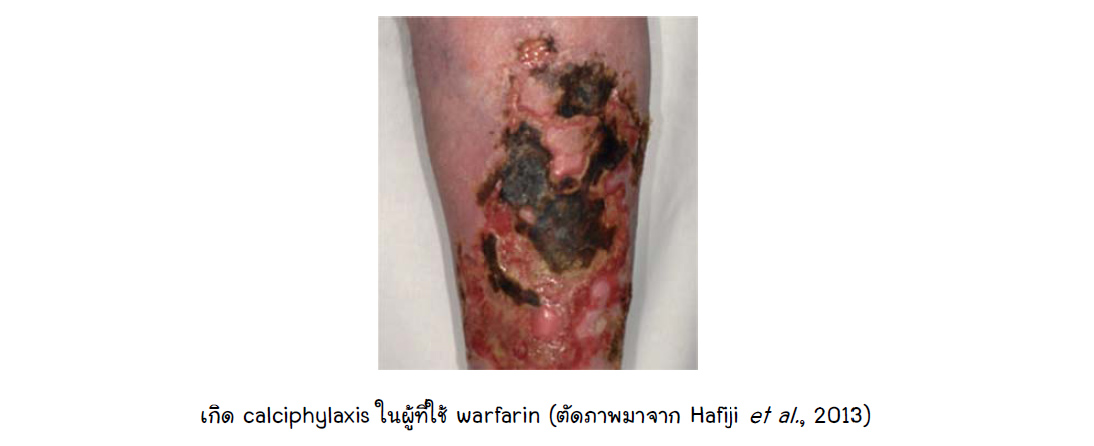 warfarin induced calciphylaxis